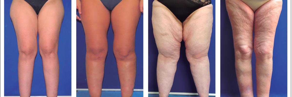 Lipedema en valencia